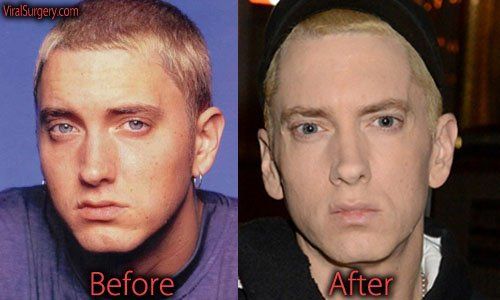 Chanel reccomend Eminem facial surgery