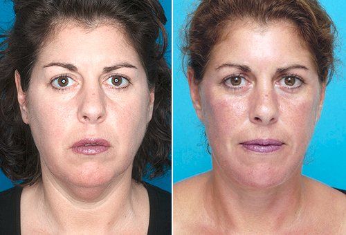 Facial rejuvanation procedures