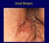 Herpes and anus and hemorrhoids