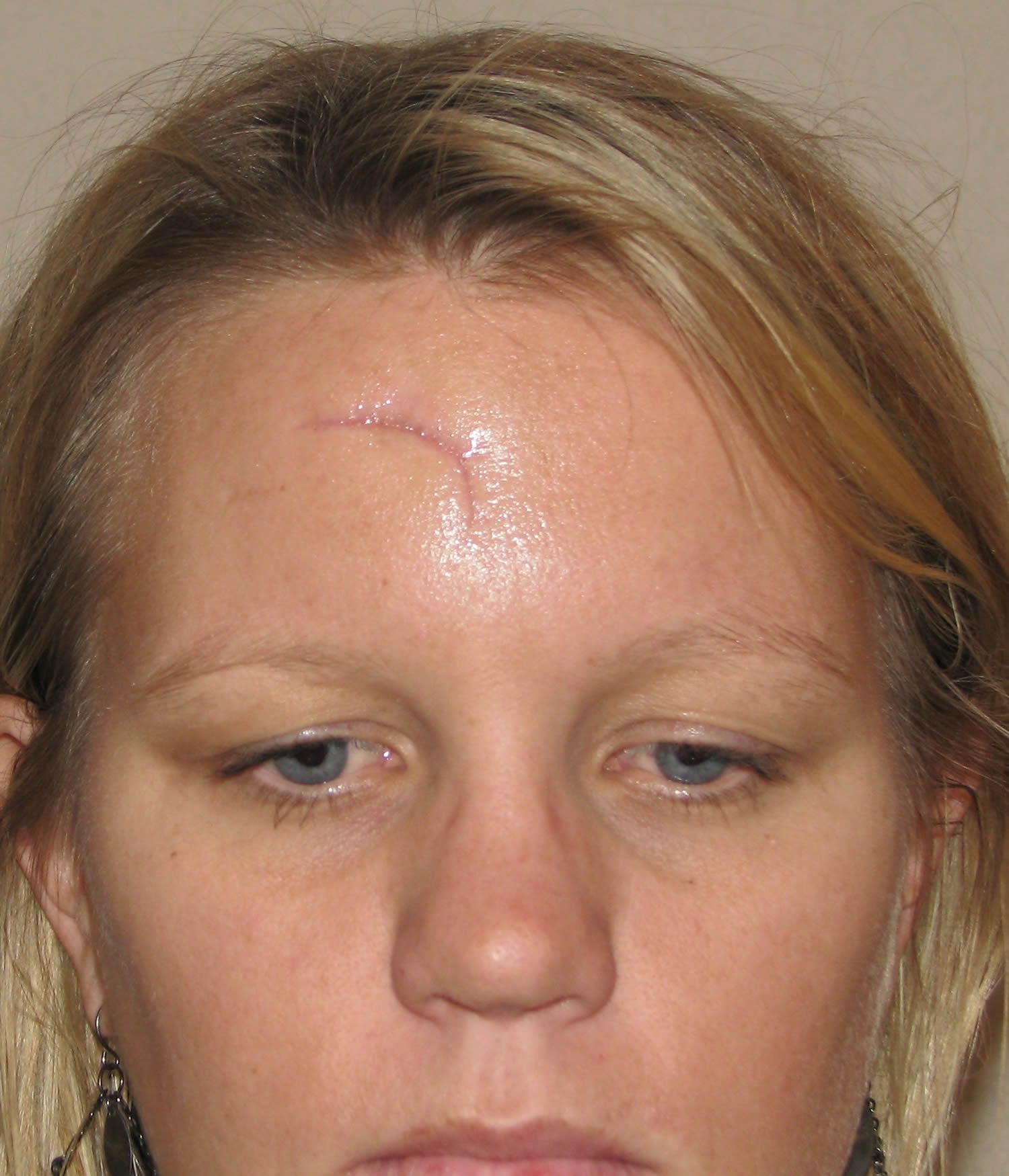Quest reccomend Facial laceration scar fading