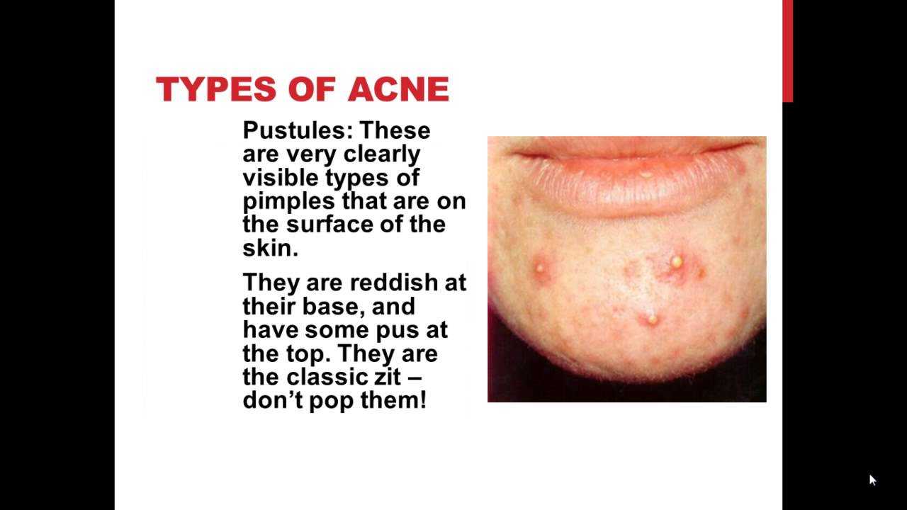 Types of facial scars
