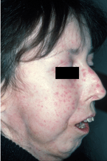 best of Scleroderma changes Early facial associated with