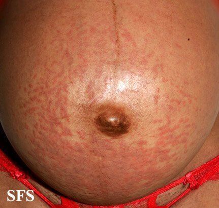 Pregnant with itching bumps near anus