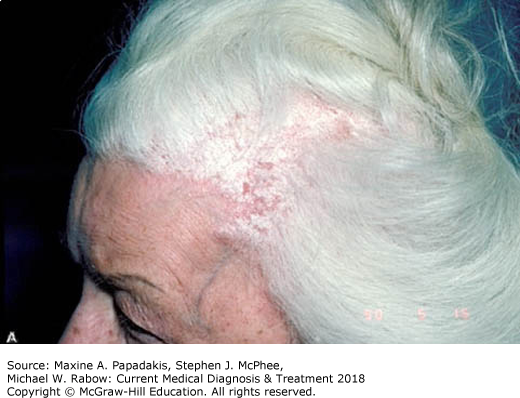 best of Pictures seborrhea Treatment Naked 2018 dermatitis for facial