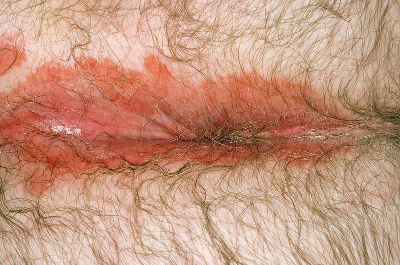 Bumble B. reccomend Scoriasis at anus