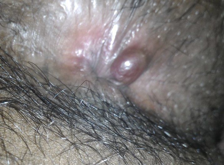 Wildberry reccomend Pimple around anus