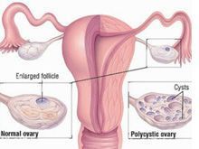 best of Sex on pcos Oral