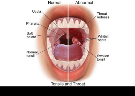 Raptor reccomend Can vaginal infection cause strep throat