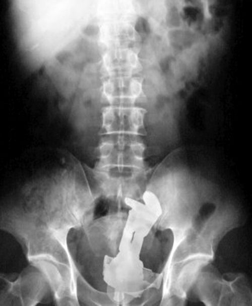 Bizzare anal x-rays