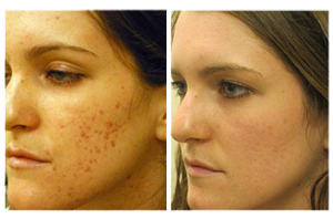 best of Facial resurfacing stories Acne scar