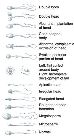 Junior reccomend Human sperm tail abnormalities