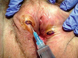 Biopsy infection of vulva
