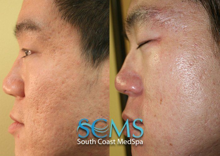 best of Facial resurfacing stories Acne scar