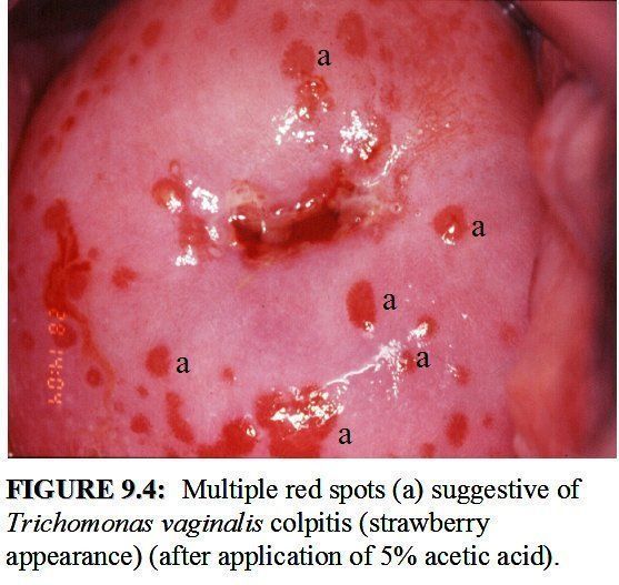 Biopsy infection of vulva