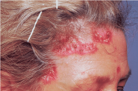 Abbot reccomend Scleroderma plaque fibrosis facial lesions
