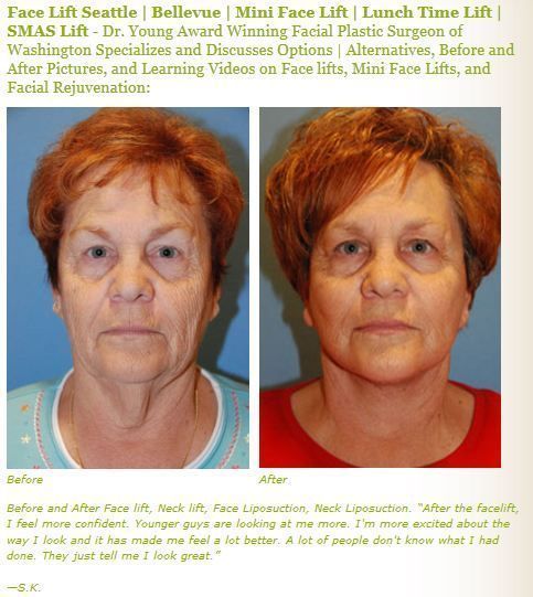 Dragonfly reccomend Facial plastic surgeons seattle