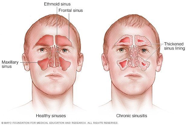 New Y. reccomend Sinus facial pain jaw