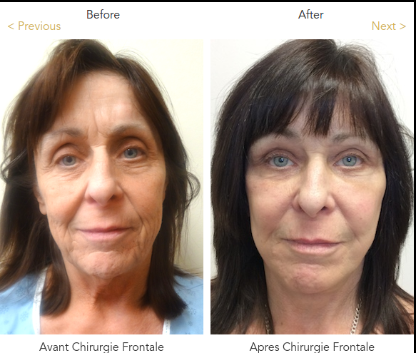 best of Rejuvanation procedures Facial