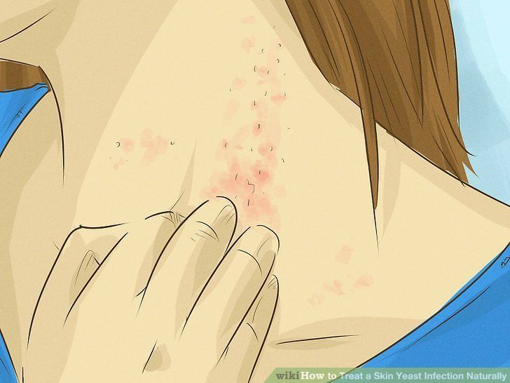Cure facial infections at home