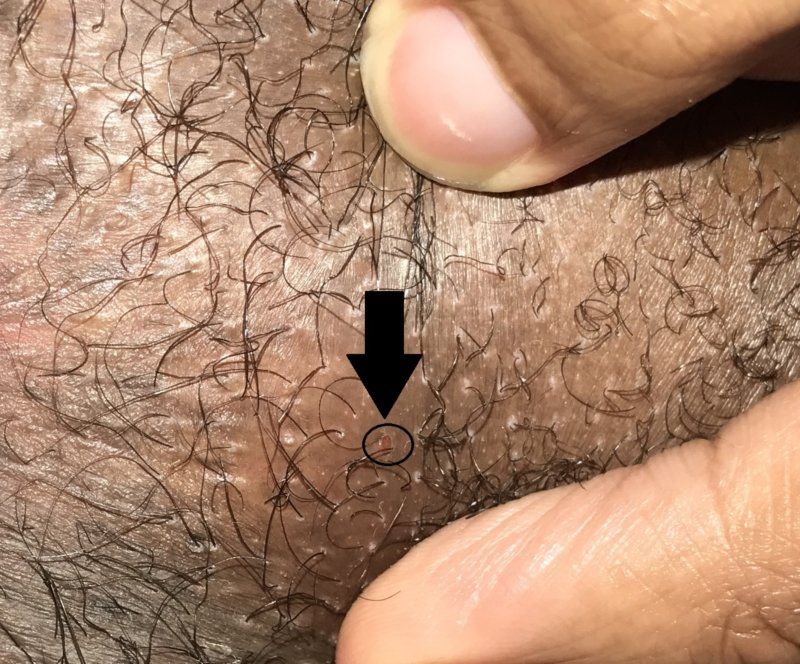 best of And anus and hemorrhoids Herpes