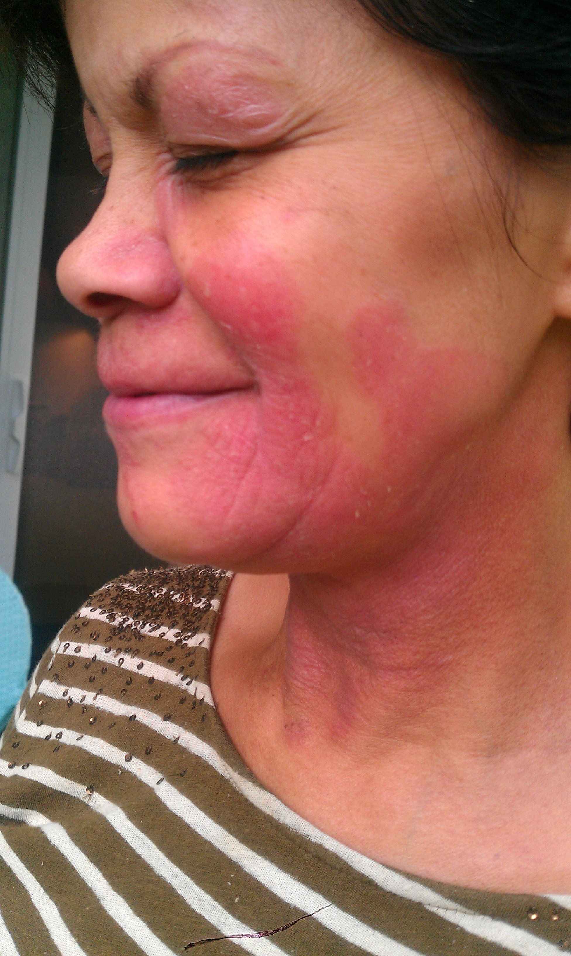 Bronze O. reccomend Blotchy facial rash