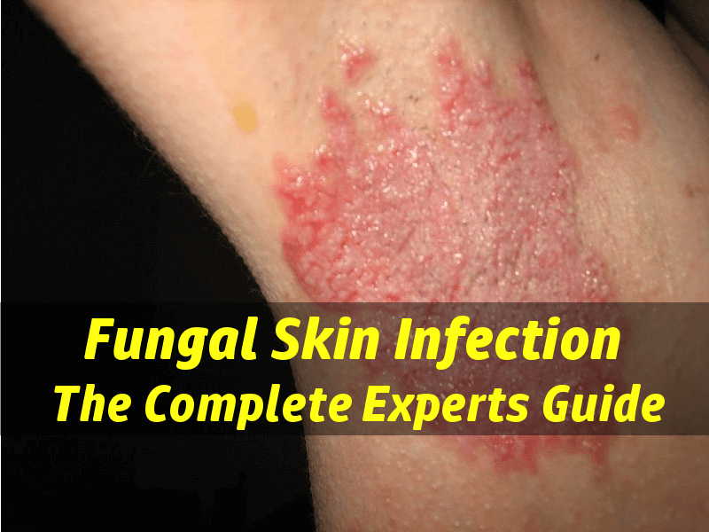 best of Infections home facial Cure at