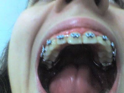 best of Fetish Orthodontic braces story