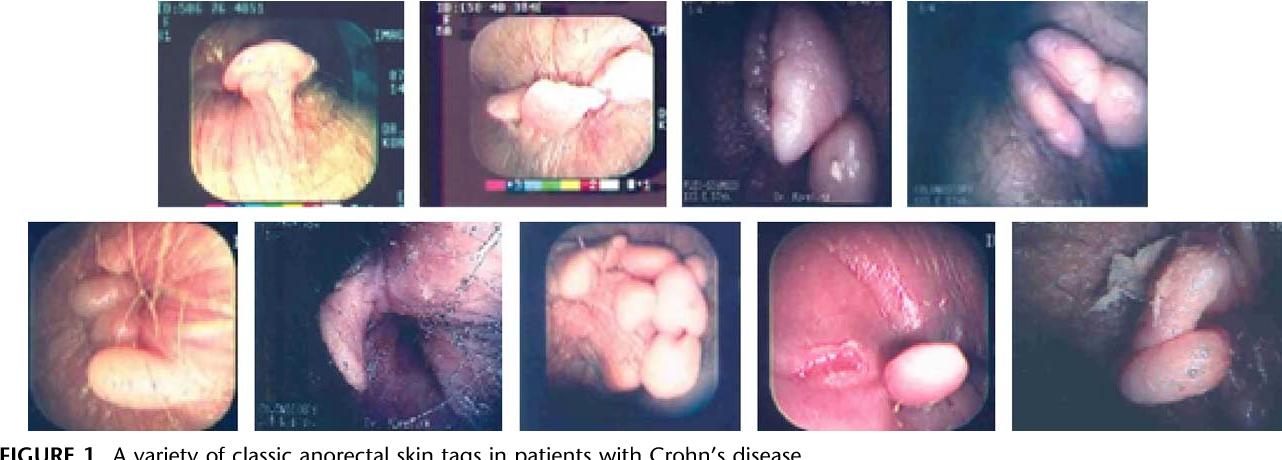 best of Anal crohns Pics tags of