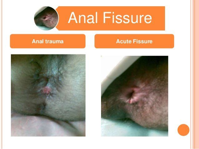 Giggles reccomend Anal fissure sex