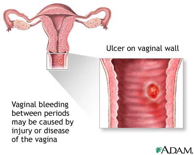 Clitoris bleeding mensruation