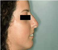 best of Scleroderma changes Early facial associated with