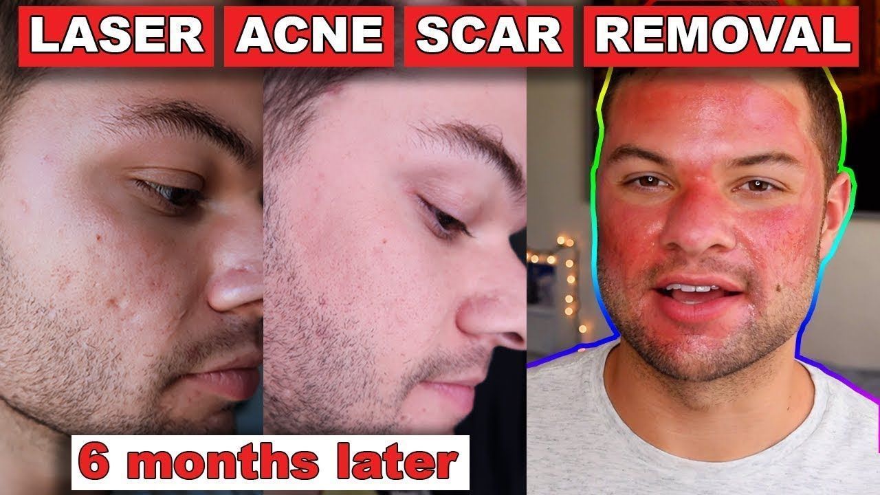 Acne scar facial resurfacing stories