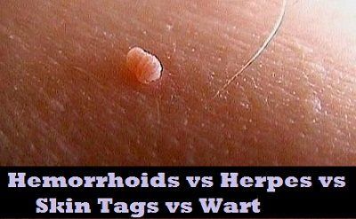 best of And anus and hemorrhoids Herpes
