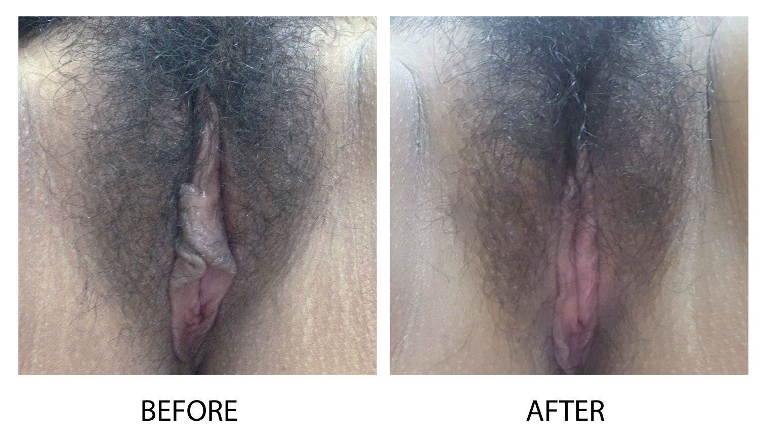 Anal bleaching before and after pictures