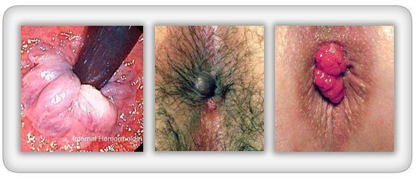 General reccomend Burning pain swollen irritation around anus