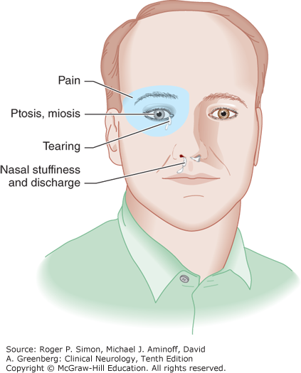 Facial postherpetic neuralgia