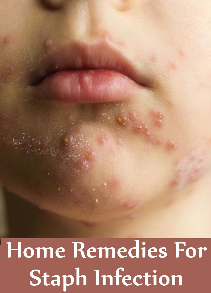 Cure facial infections at home