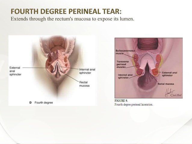 Rep reccomend Cure for anal incontinence after episiotomy
