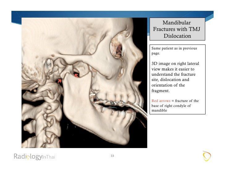 best of And facial multiple fractures Disloacted jaw