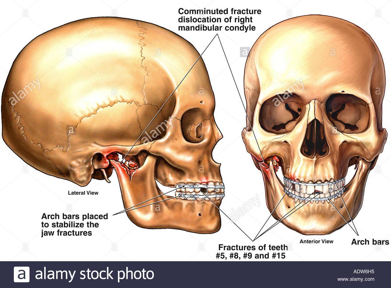 Valentine reccomend Disloacted jaw and multiple facial fractures