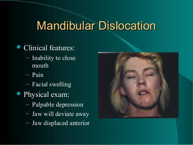 Disloacted jaw and multiple facial fractures