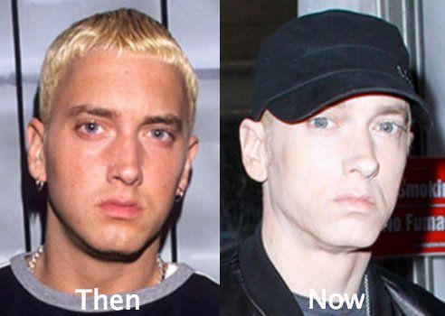 Watson reccomend Eminem facial surgery