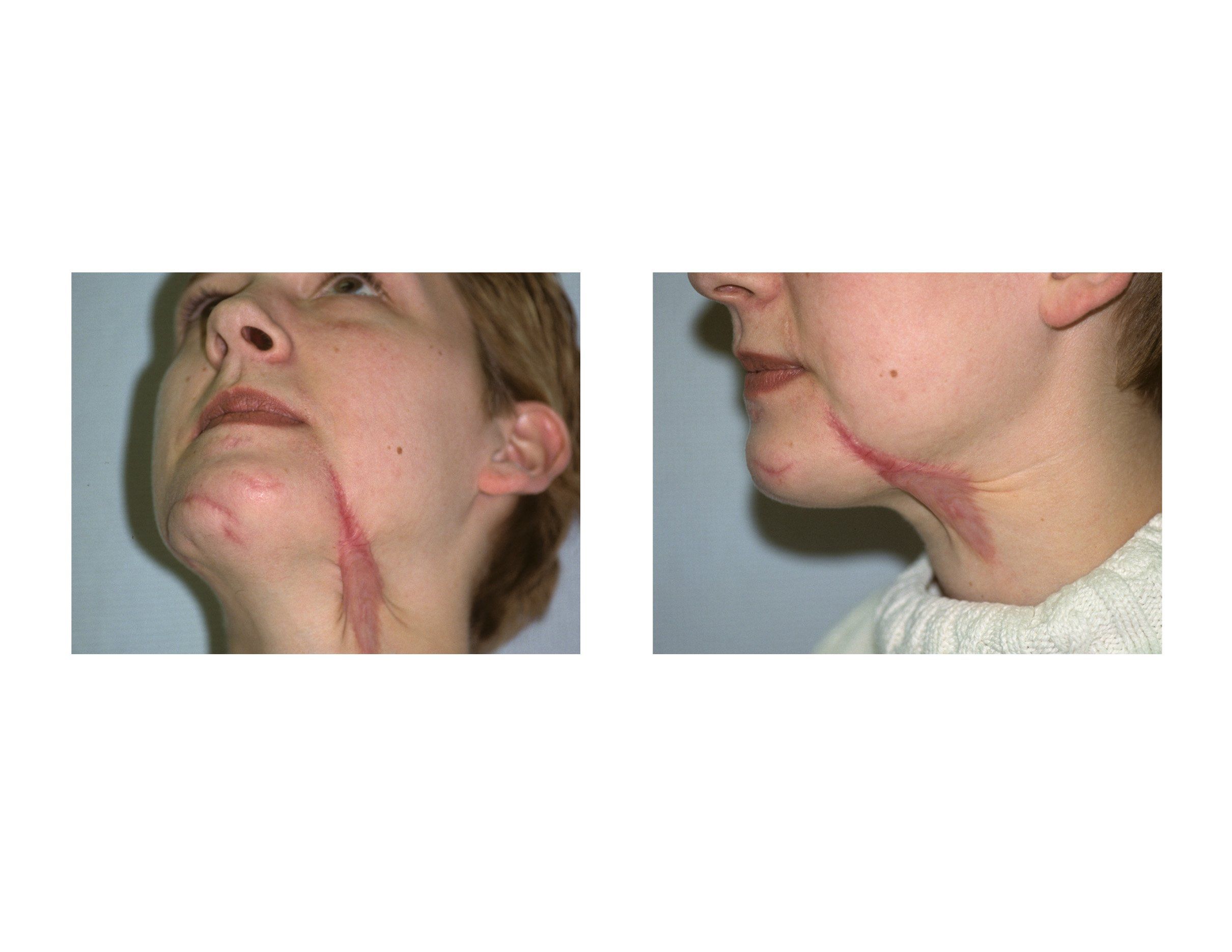 Facial laceration scar fading