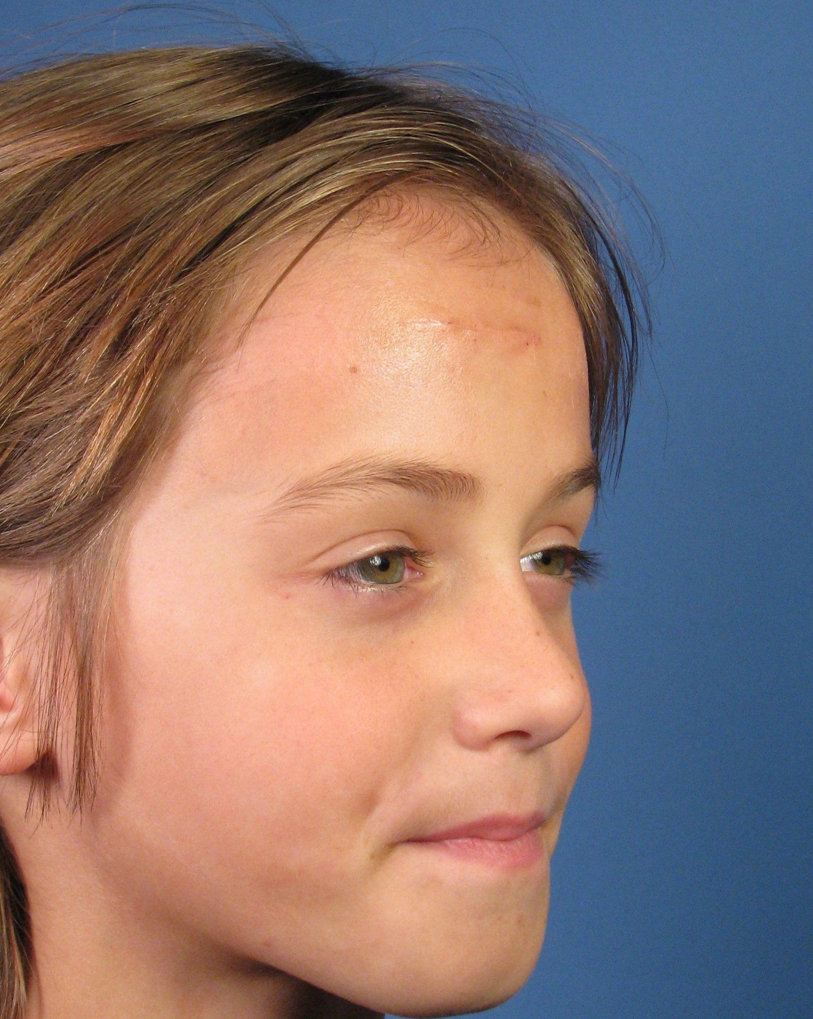 Wonder W. reccomend Facial laceration scar fading