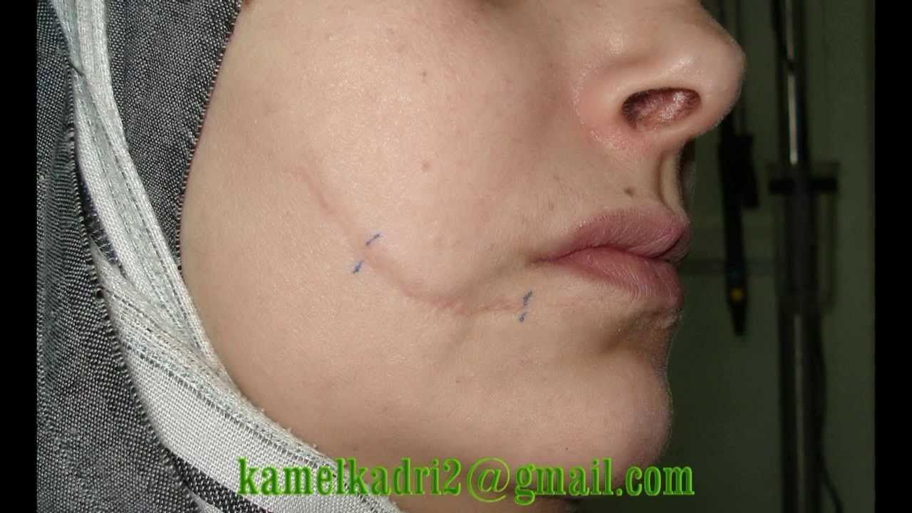 Princess reccomend Facial laceration scar fading