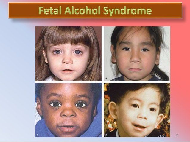 Fetal alcohol spectrum disorders + facial + pictures