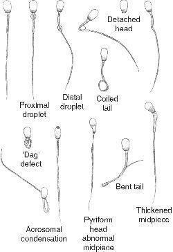 best of Tail Human abnormalities sperm