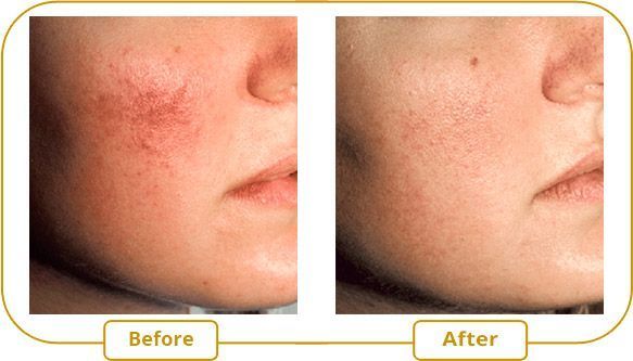 best of For capillaries Laser facial