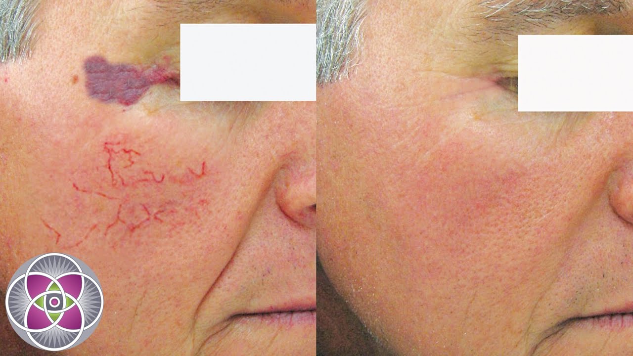 best of For capillaries Laser facial
