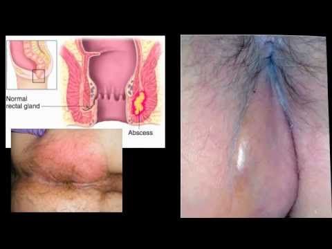 Leo reccomend Painful pimples around my ass hole